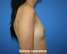 plastic-surgery-breast-augmentation